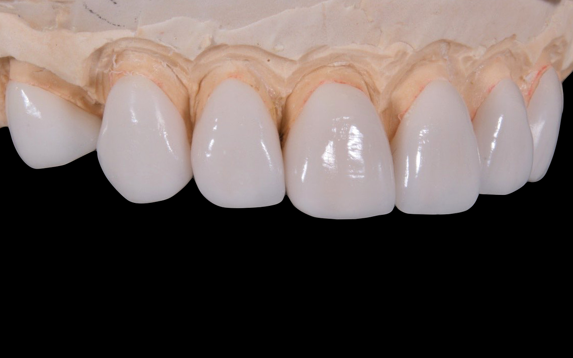 dental, porcelain tooth, wax separated by commas-2036945.jpg